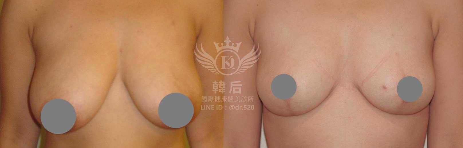 韓后醫美,隆乳,重修乳房,重修假體義乳,縮乳,胸部提升,素人真實案例