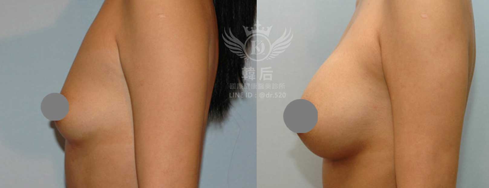 韓后醫美,隆乳,胸部提升,自體脂肪豐胸,E罩杯,F罩杯,真實案例素人真實案例