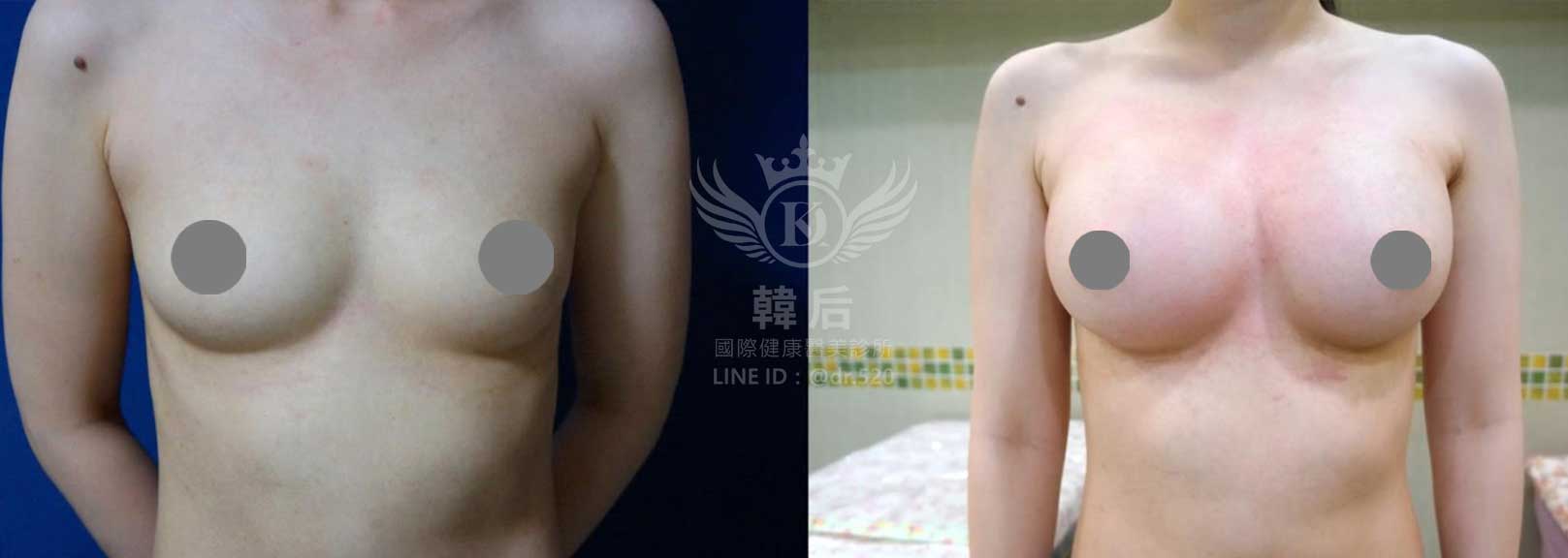 韓后醫美,隆乳,胸部提升,自體脂肪豐胸,E罩杯,F罩杯,真實案例素人真實案例
