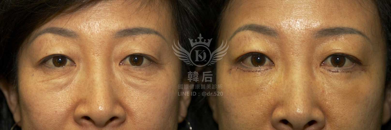 韓后醫美,除眼袋,消除淚溝,手術,免手術,自體脂肪填補,膠原蛋白填補,真實案例素人真實案例