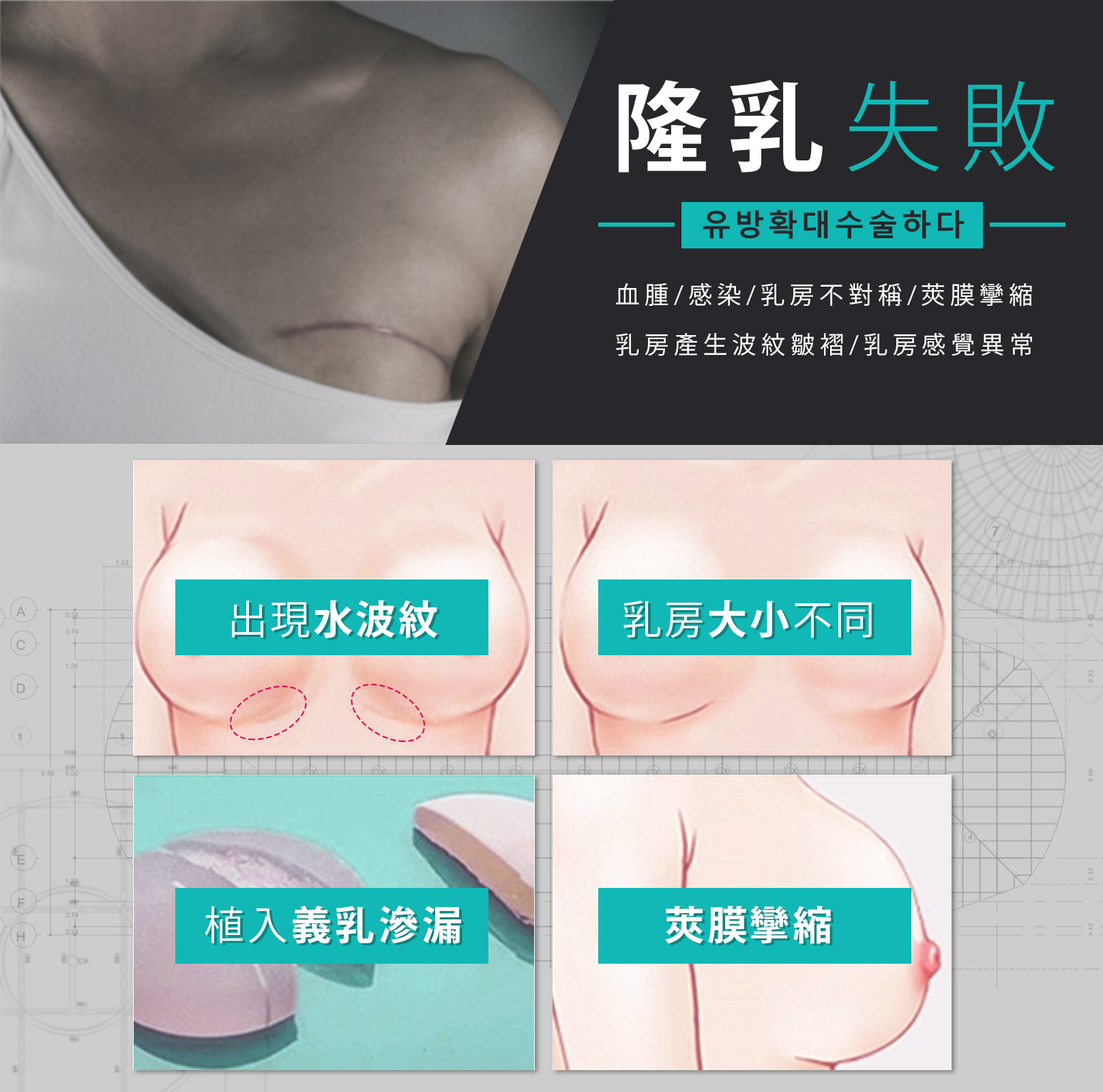 隆乳失敗 血腫 感染 乳房不對稱 莢膜攣縮 乳房產生波紋皺褶 乳房感覺異常 出現水波紋 義乳滲漏