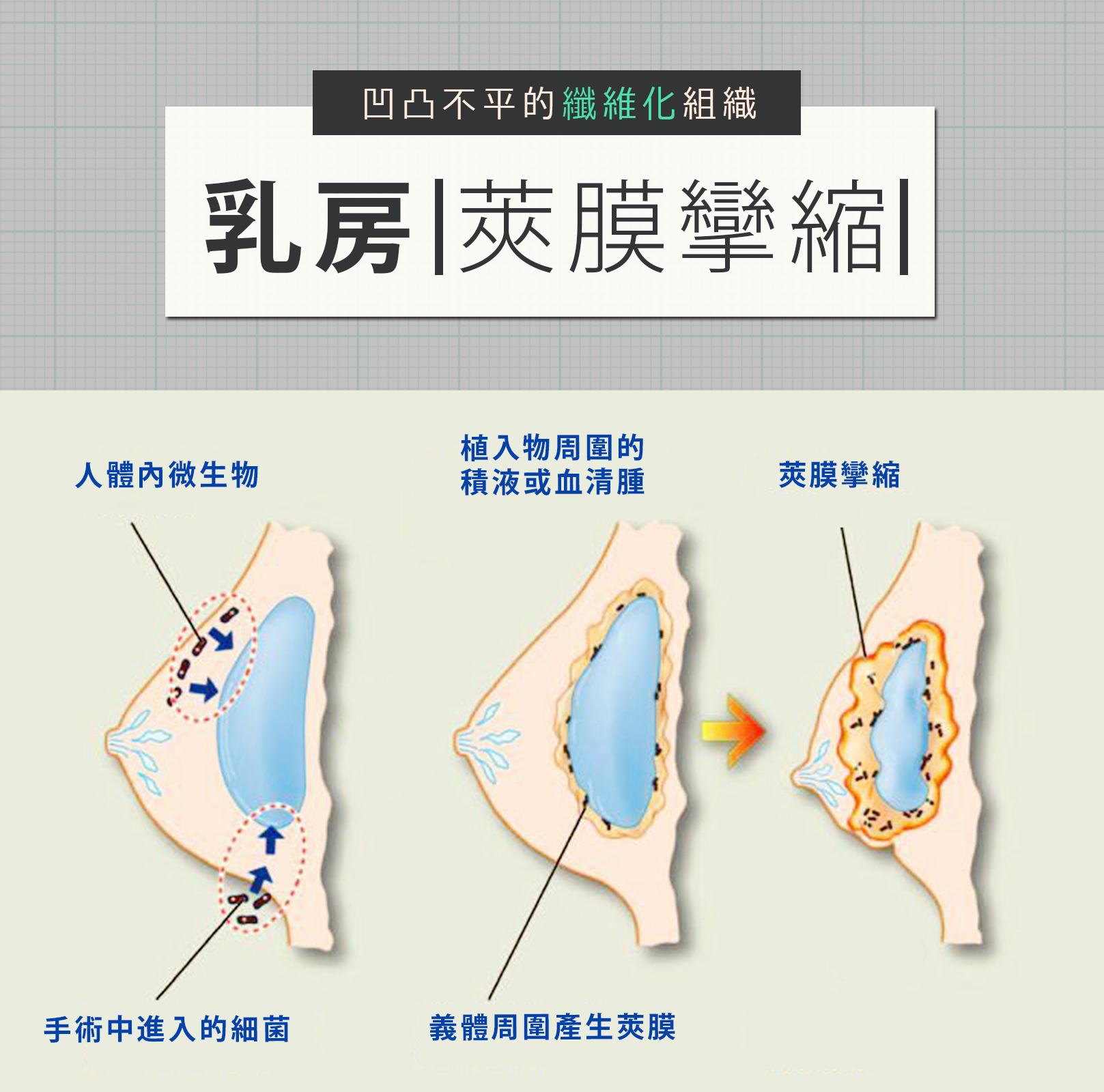 凹凸不平的纖維化組織-乳房夾饃攣縮 人體內微生物 植入物周圍的積液或血清腫 莢膜攣縮