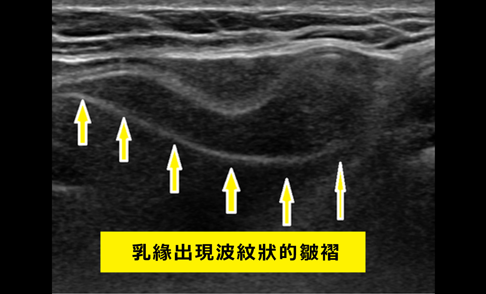 乳緣出現波紋狀的皺褶