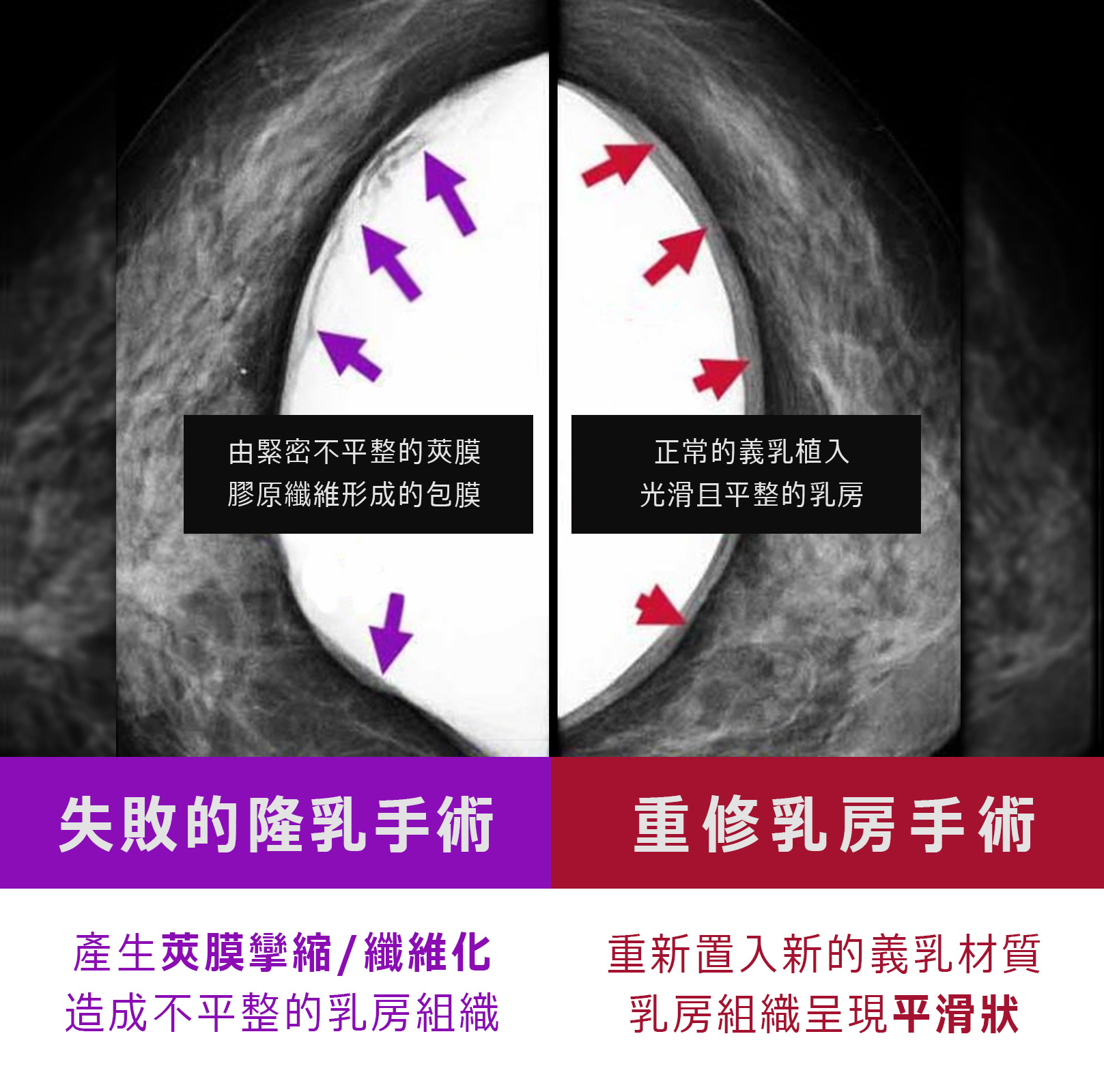 失敗的隆乳手術-產生莢膜攣縮/纖維化，造成不平整的乳房組織。重修乳房手術-重新置入新的義乳材質，乳房組織呈現平滑狀。