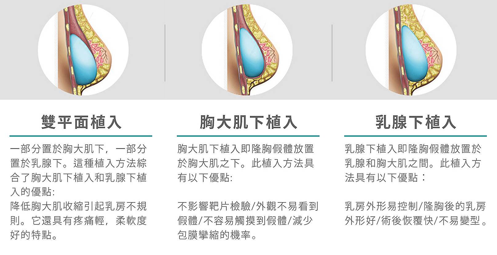 雙平面植入、胸大肌下植入、乳腺下植入。