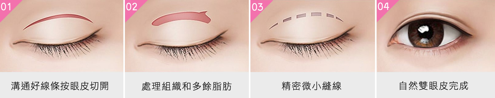 韓后-韓式無痕割雙眼皮方式：1.溝通好線條按眼皮切開。2.處理組織和多餘脂肪。3.精密微小縫線。4.自然雙眼皮完成。