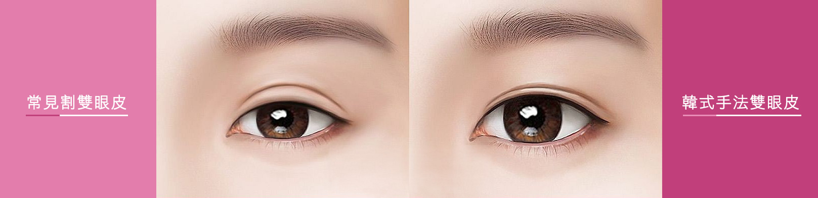 韓后-常見割雙眼皮、韓式手法雙眼皮。
