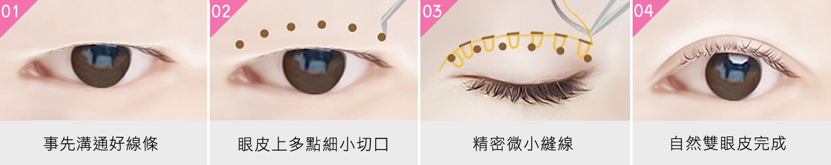 韓后-韓式無痕縫雙眼皮方式-1.事先溝通好線條。2.眼皮上多點細小切口。3.精密微小縫線。4.自然雙眼皮完成。