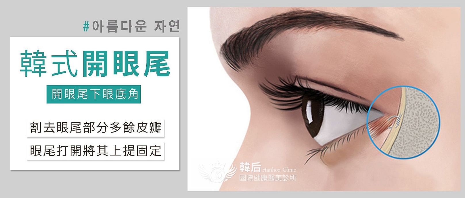 韓后 韓式開眼尾下眼底角：1.割去眼尾部分多餘皮瓣。2.眼尾打開將其上提固定。
