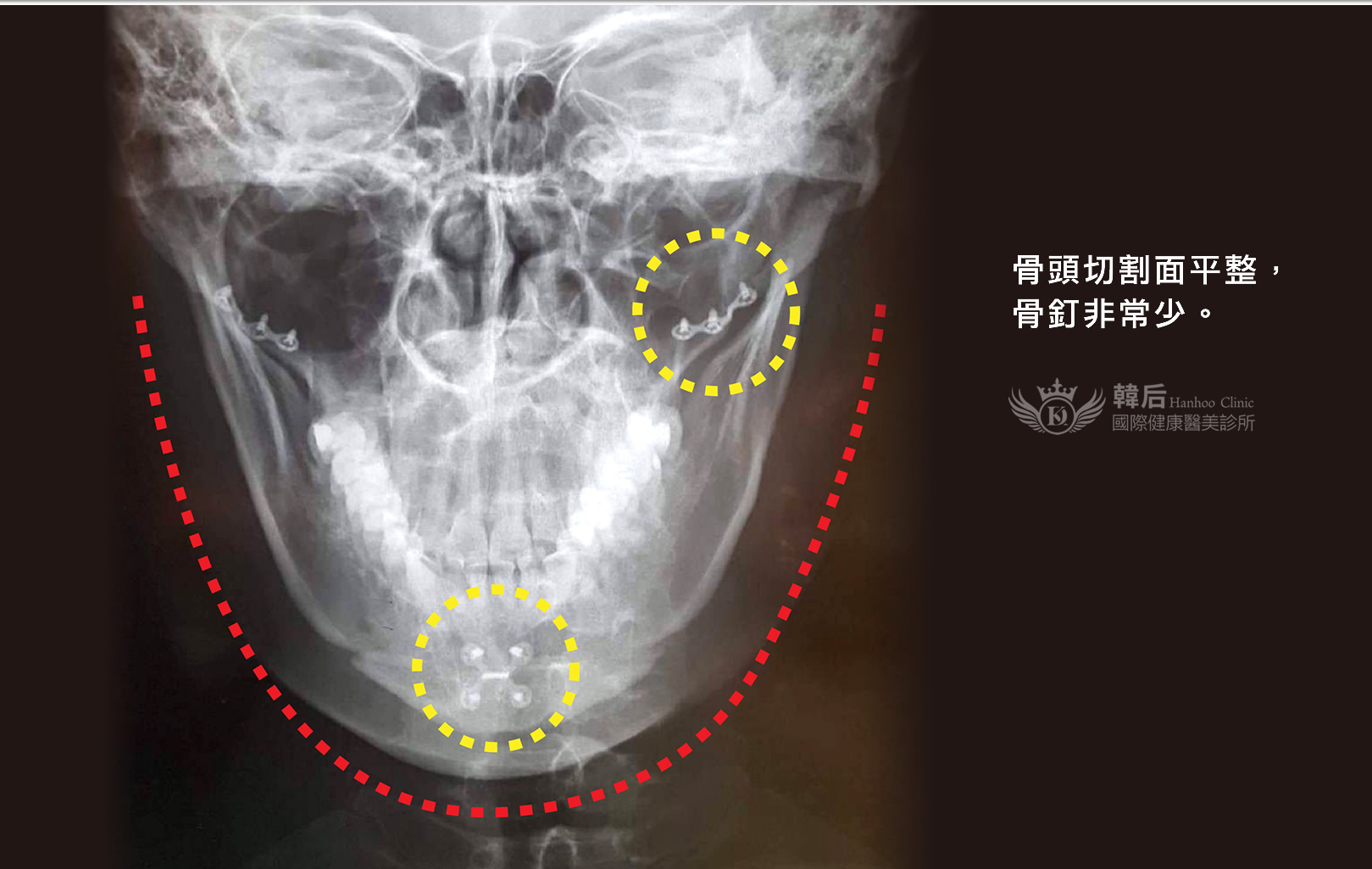 韓后醫美 成功的削骨手術