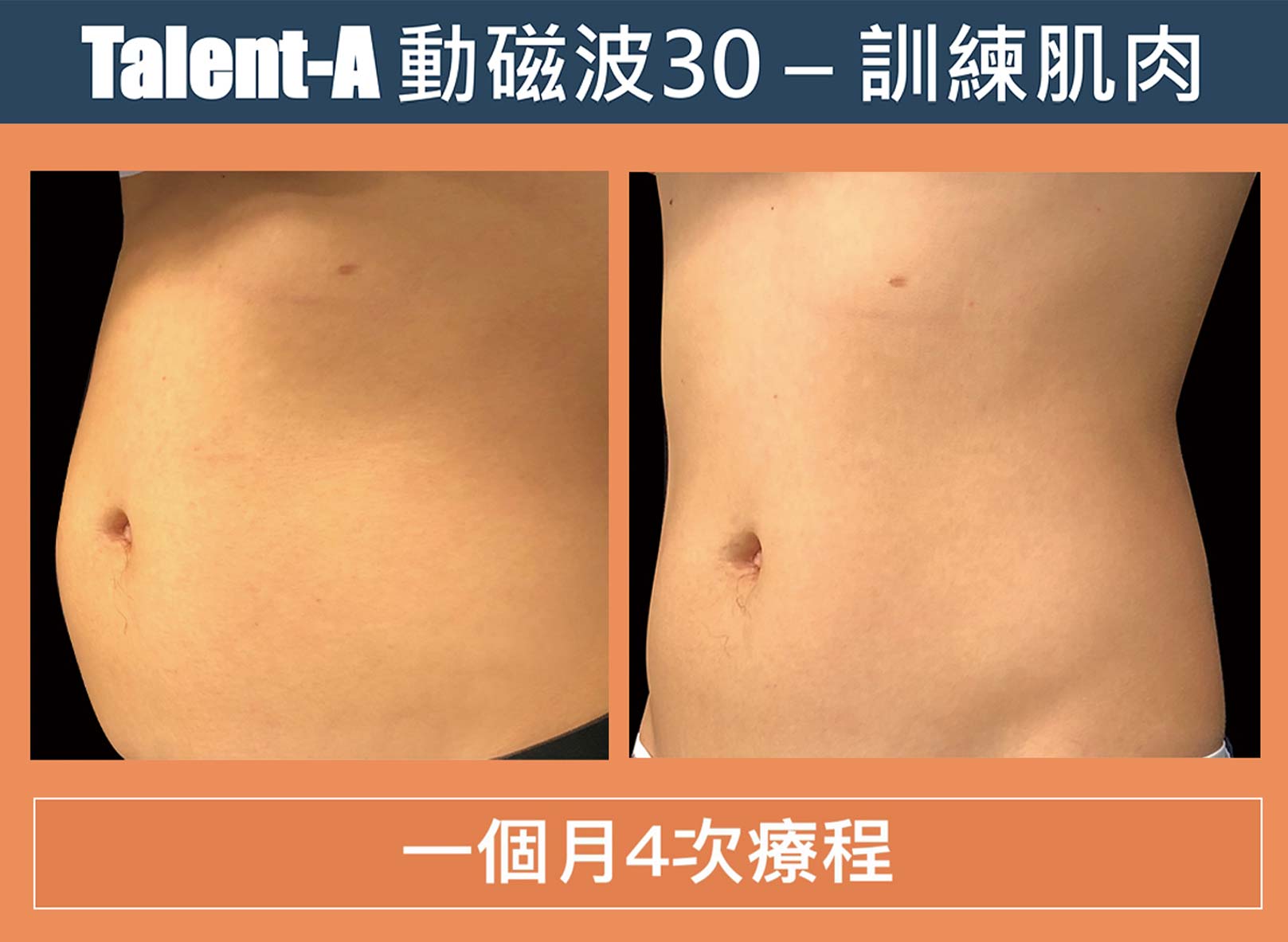 長著長腹肌,一個月4次療程前後,韓后醫美,動磁波,Talent-A